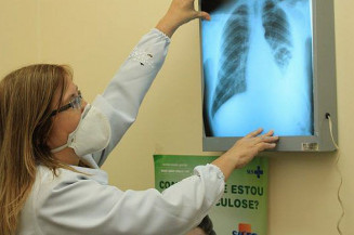 Pesquisadores do Brics buscam interconexões entre tuberculose e covid