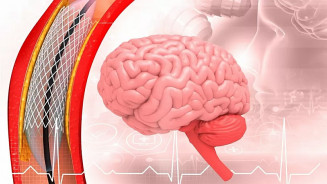 SUS incorpora trombectomia para tratar casos graves de AVC