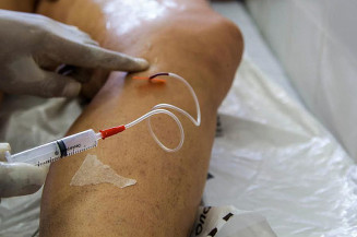 A cada dia, 145 mulheres são internadas para tratar varizes